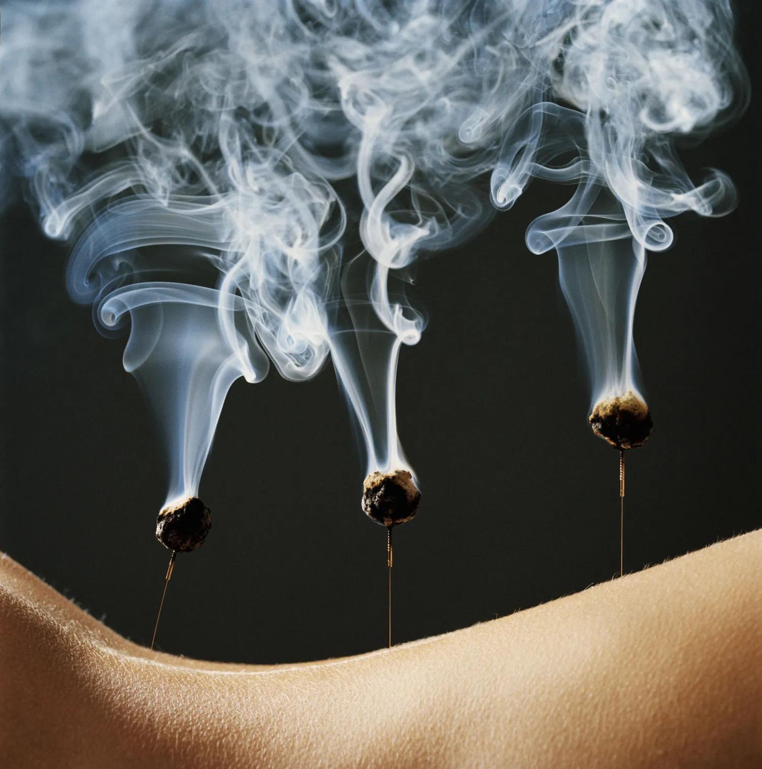 Moxibustion 1